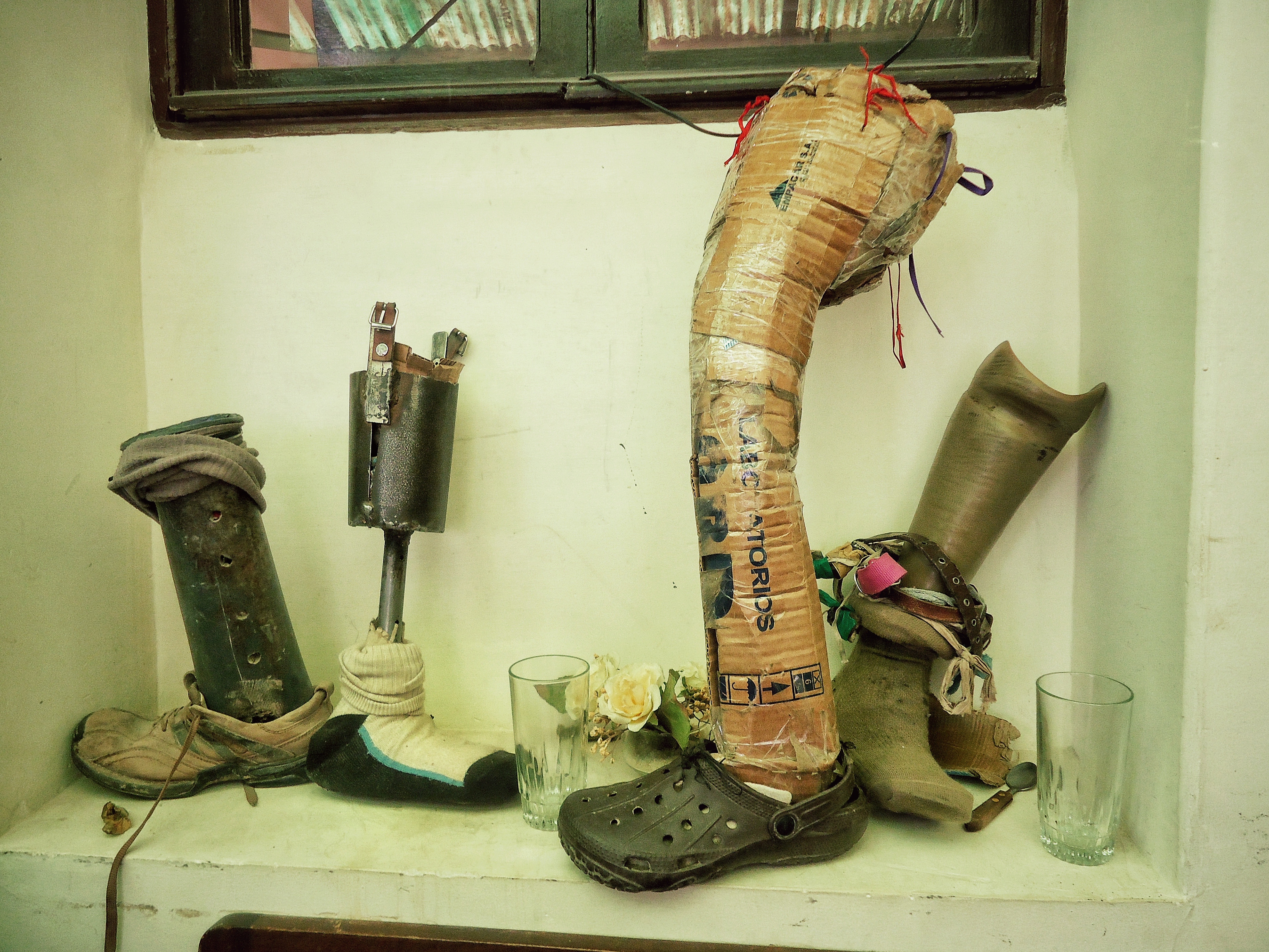 This Is What It's Like To Live With A Prosthetic Leg